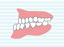 反対咬合のイラスト